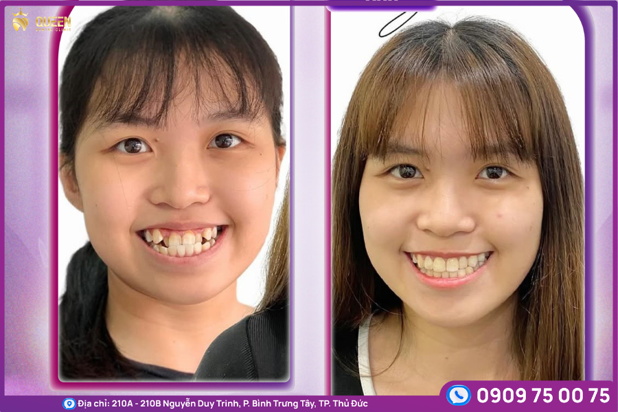 kết quả niềng răng tại nha khoa Queen