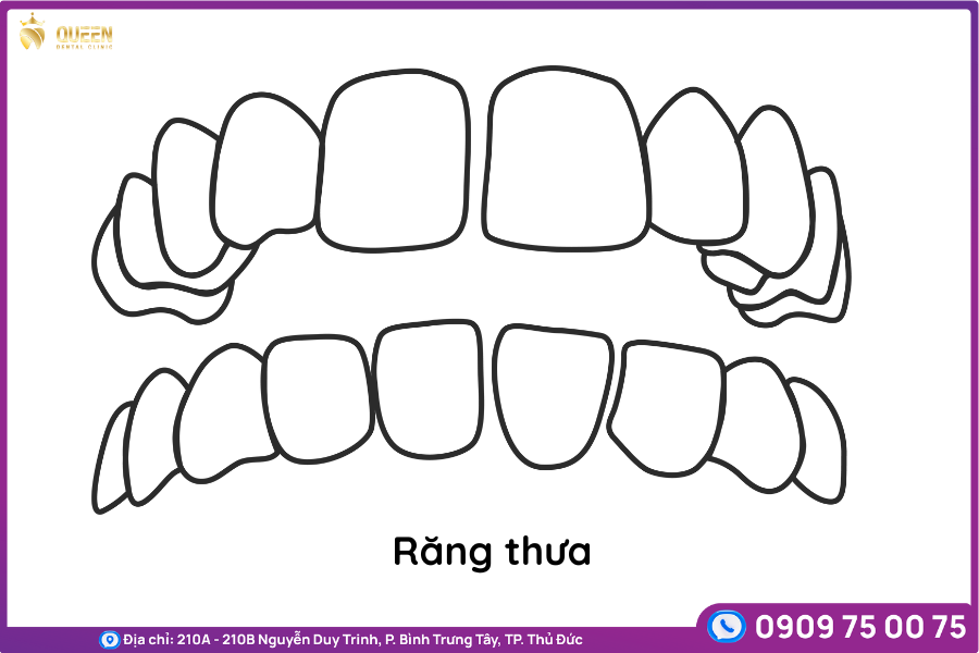 niềng răng thưa