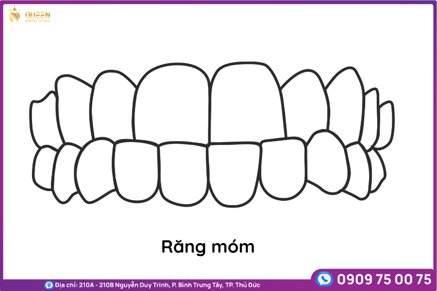 niềng răng móm