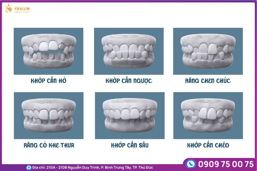 các trường hợp niềng răng