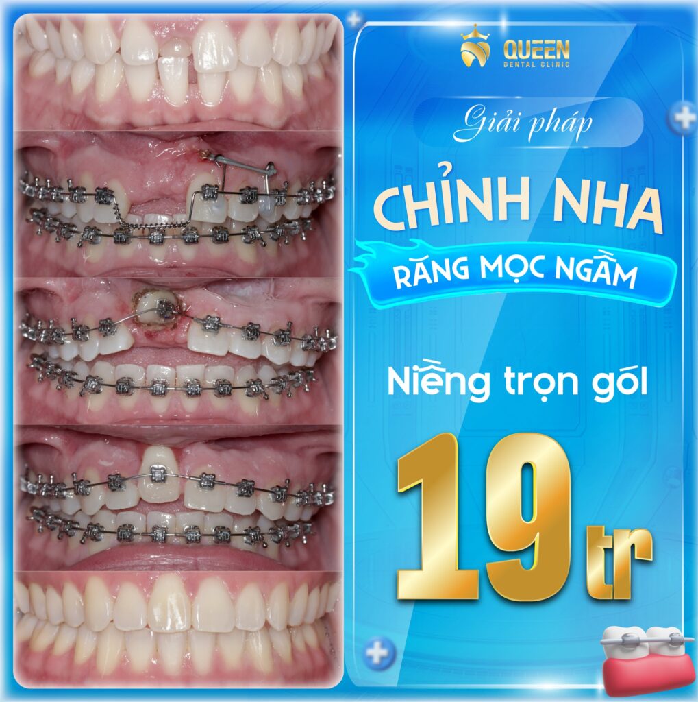 ưu đãi niềng răng mùa hè